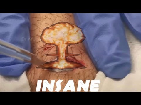 Comedones! 8 Minutes of Pimple Pops! Best Pimple Popping