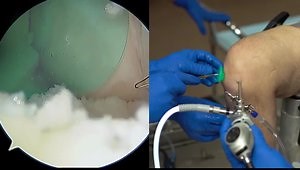 All-Inside ACL Reconstruction Using Retrograde Reaming