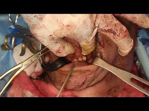 Glossectomy and buccinator myomucosal reconstruction Dr. Mohamed Elshamaa