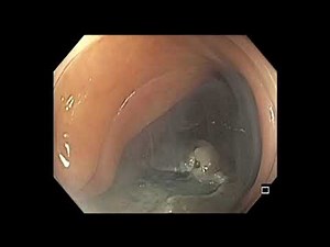 Colonoscopy: Ascending Colon LST-G Tumor 4 cm - Piecemeal EMR • Video • MEDtube.net
