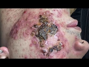 Extreme Acne & Scab Removal | Deep Pimple Popping for Severe Skin Recovery