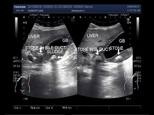 Ultrasound Video showing a stone each in Gall Bladder and Bile duct.