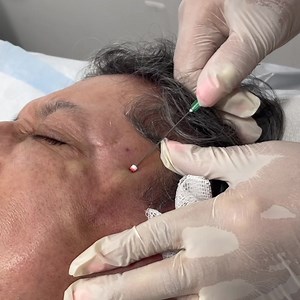 PDO threads are finally here. PDO thread procedure is usually done for any type of a lift or add volume. on the face, neck, jowls, jawline, nasolabial folds, under eye, cheeks, eye brows marionette lines. Give us a call to set up you appointment or consultation. (410)768-0262 www.womenshealthofmd.com #pdothreads #pdothreadlift #pdo | Women's Health Services of Maryland | Facebook