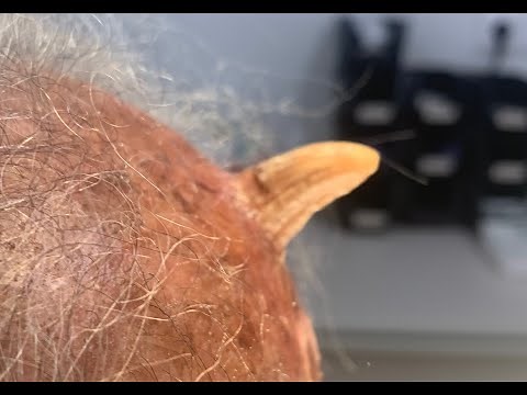 ΔΕΡΜΑΤΙΚΟ ΚΕΡΑΣ: Ευμεγέθης υπερκεράτωση του δέρματος