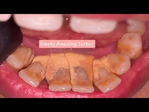 Teeth Cleaning Tartar / Calculus Removal Before n After- satisfying video #subscribe #calculus #001