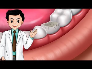 Cracked Molar Treatment Explained | Dental Education"