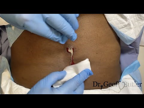 Drainage of an infected cyst on the back