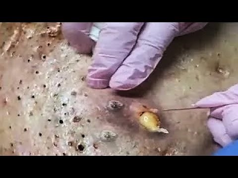 Big Cystic Acne Blackheads Extraction Blackheads & Milia, Whiteheads Removal Pimple Popping 13