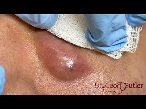 Drainage of an infected epidermal cyst on the face
