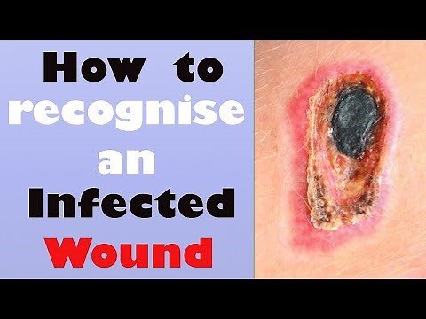 How to recognize an Infected Wound
