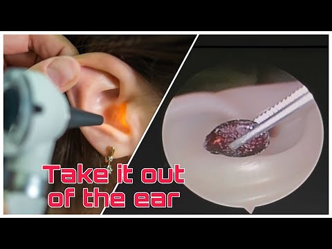 The Surprising Truth About Ear Foreign Bodies | 耳の異物除去