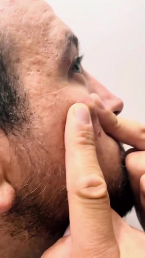 pimples on faces #cravos #blackhead #zit #popper #acne | Peach Slices Acne Patches