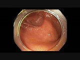Colonoscopy - Cecal EMR Scar • Video • MEDtube.net