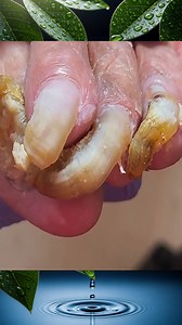 Toenail Cleaning 360 | Toenail 99