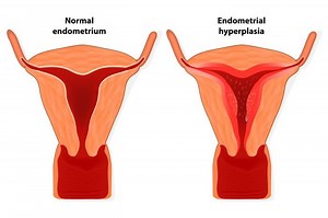 Fungsi Endometrium pada Organ Reproduksi Wanita - Sonora.id