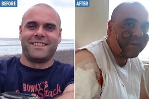 Flesh-eating face ulcers and pus-filled boils have left me looking like a Zombie