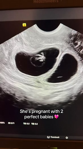 IVF Embryo Transfer Success: Pregnant with Two Healthy Babies