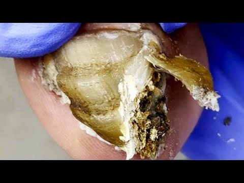 Layers Of Onychomycosis With A Lot Of Black Mud Inside【Dr. Liu's Pedicur】