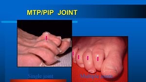 Management of Lesser Toe Deformities
