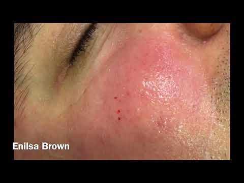 Christian's Acne Treatment ( Blackheads Extractions)