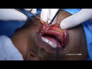 Reduce Lower Lip by Lip Surgery | Lip Reduction Surgery Procedure by Dr. Richardson