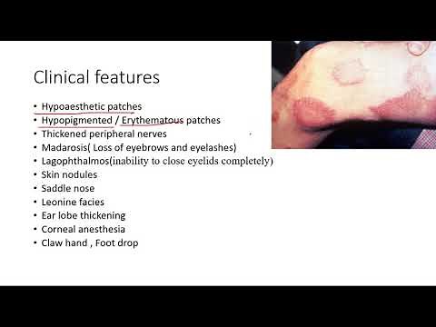 Leprosy(Hansen's disease): Pathogenesis, Clinical features and treatment l USMLE