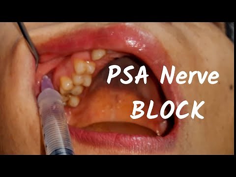 Posterior Superior nerve Block (PSA) Inj in #dentistry Landmark & Technique in Dental Teeth Surgery