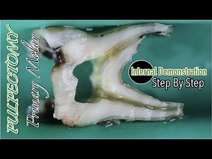 Pulpectomy in Primary Mandibular Molar | Internal Demonstration | Step By Step • Video • MEDtube.net