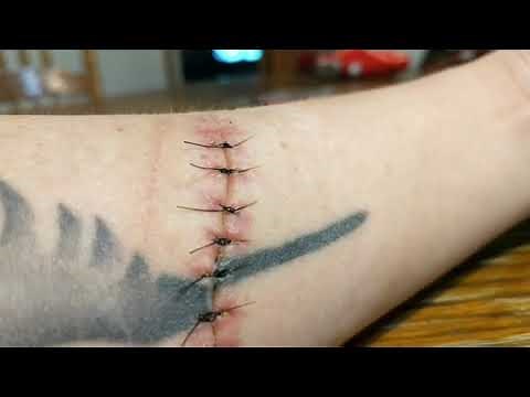 ( Graphic) Today we learn how to remove our stitches