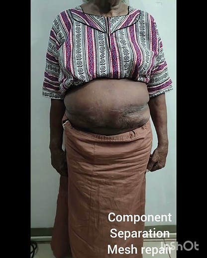 Incisional hernia repair using component separation