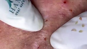 Big Cystic Acne Blackheads Extraction Blackheads & Milia, Whiteheads Removal Pimple Popping