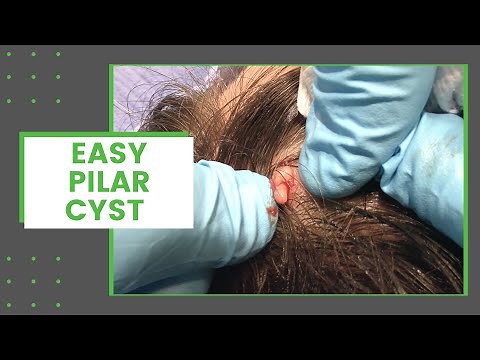 Easy Pilar Cyst | Dr. Derm