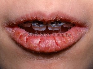 VisualDx - Cheilitis