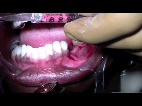 Dental Bone Graft - Tunnelling