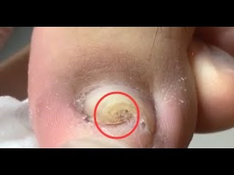 How to cut super curled nail