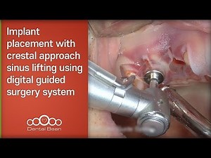 Implant placement with crestal approach sinus lifting using digital guided surgery-[Dr. Kim Yongjin]