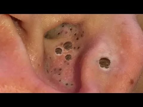 Blackhead Removal | Ear Blackheads Removal
