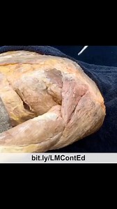 🔹 LearnMuscles.com 🔹 Excellence-in-education 🏅 🌟 Beautiful cadaver dissection video showing the infraspinatus muscle of the rotator cuff group. 🔸️This is a posterior view of the right shoulder region. We can see some of the infraspinatus, but much of it is deep to the deltoid, so 🔸️the posterior deltoid is cut and reflected away and now we can see all of the infraspinatus. 🔸️The infraspinatus attaches from the infraspinous fossa of the scapula to the greater tubercle on the head of the hu
