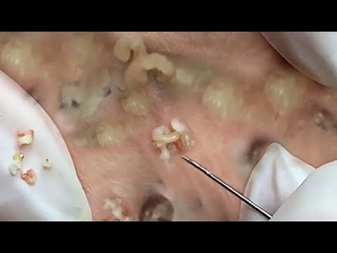 Deep blackhead extraction Cystic acne & pimple popping #1