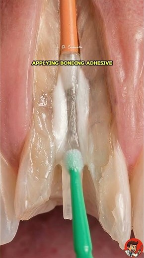 Dental Transformation: Tooth Rebuild Process