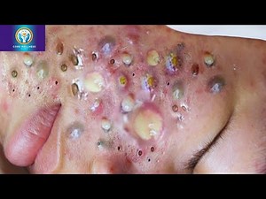 The Scar-Free Method: Dermatologist Reveals PROVEN Cystic Acne Drainage Technique for Instant Pain
