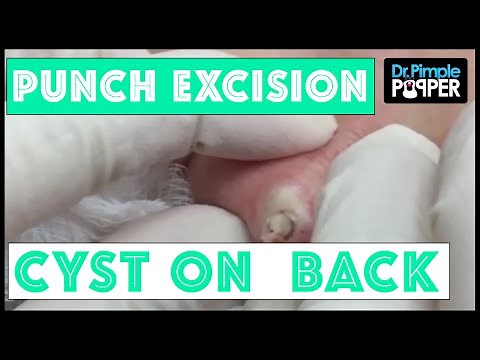 A recurrent cyst removed via punch biopsy tool