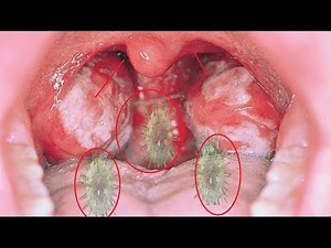 Home Remedies to Treat Mononucleosis - How to back Normal Throat!