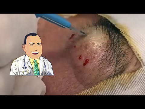 Biggest Cysts? Eyebrow Epidermoid Cyst Extracted!