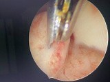 Polypectomy • Video • MEDtube.net