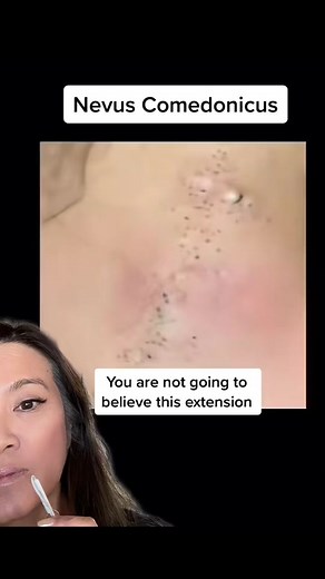 #duet with @sairashairyworld #extractions its good luck if you know someone with a nevus comedonicus #ASMR #drpimplepopper #SLMDskincare