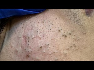Deep Cleansing Techniques For Acne — Severe Blackhead Removal