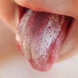 Holistic Treatment For Oral Thrush Pictures