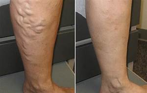 Getting Rid Of Varicose And Spider Veins Usa Vein Clinics