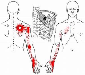 What Is Trigger Point Therapy Palmleaf Clinic Buffalo